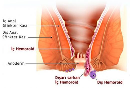 Basur Şişliği Nasıl İner?
